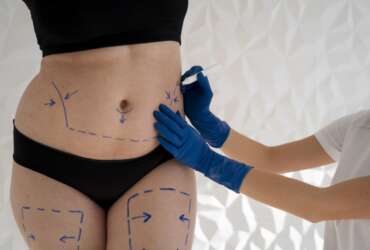 liposukcja